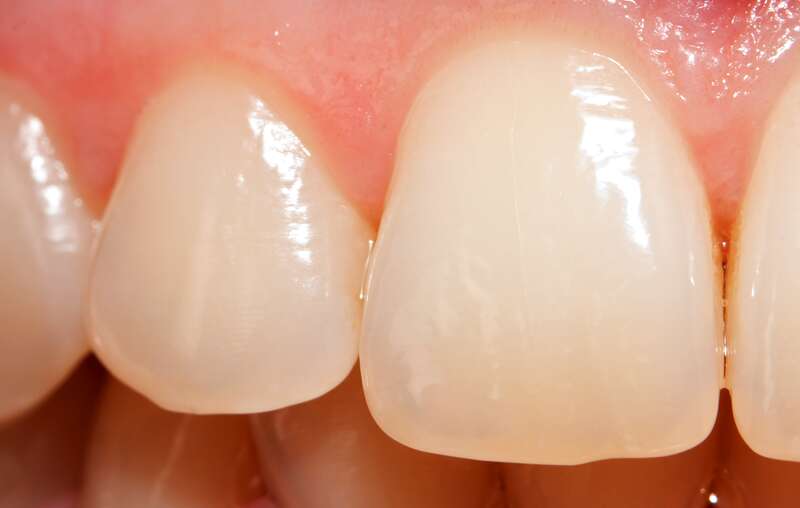 Dental Erosion