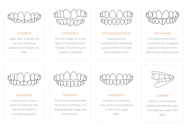 Clear Aligners